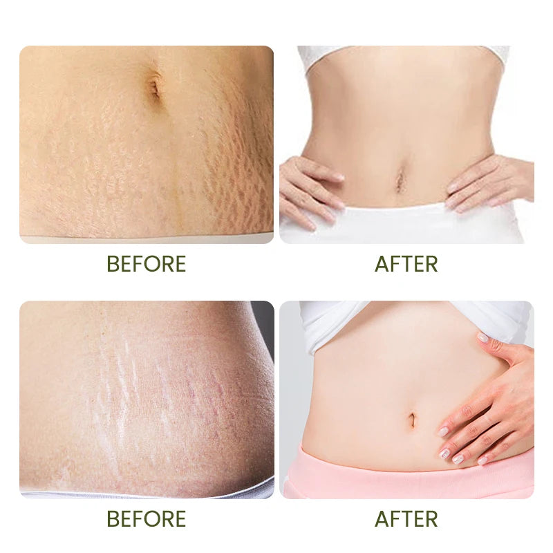 NakedSkin Stretch Mark Patch